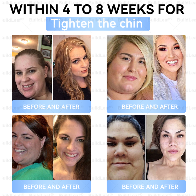 🇨🇦🇨🇦🇨🇦𝐇𝐞𝐚𝐥𝐭𝐡 𝐂𝐚𝐧𝐚𝐝𝐚 |𝐵uil𝗱𝐿ea𝐟® 𝑮𝐋𝑃-1 Slim & Firm 𝑁ano 𝑀icroneedle 𝑃atch with Collagen,Turmeric&Matrixyl 3000 丨Obesity,Cardiovascular Diseas, Diabetes, Sleep Apnea, Joint Problems and More