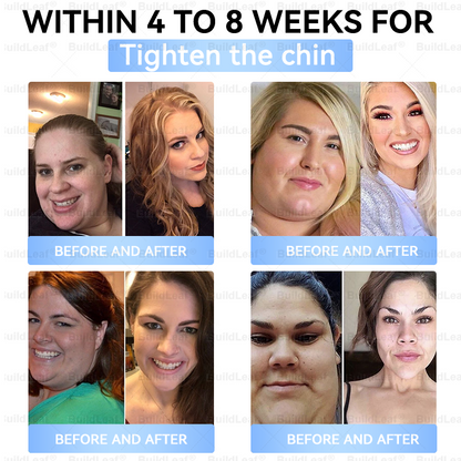🇨🇦🇨🇦🇨🇦𝐇𝐞𝐚𝐥𝐭𝐡 𝐂𝐚𝐧𝐚𝐝𝐚 |𝐵uil𝗱𝐿ea𝐟® 𝑮𝐋𝑃-1 Slim & Firm 𝑁ano 𝑀icroneedle 𝑃atch with Collagen,Turmeric&Matrixyl 3000 丨Obesity,Cardiovascular Diseas, Diabetes, Sleep Apnea, Joint Problems and More