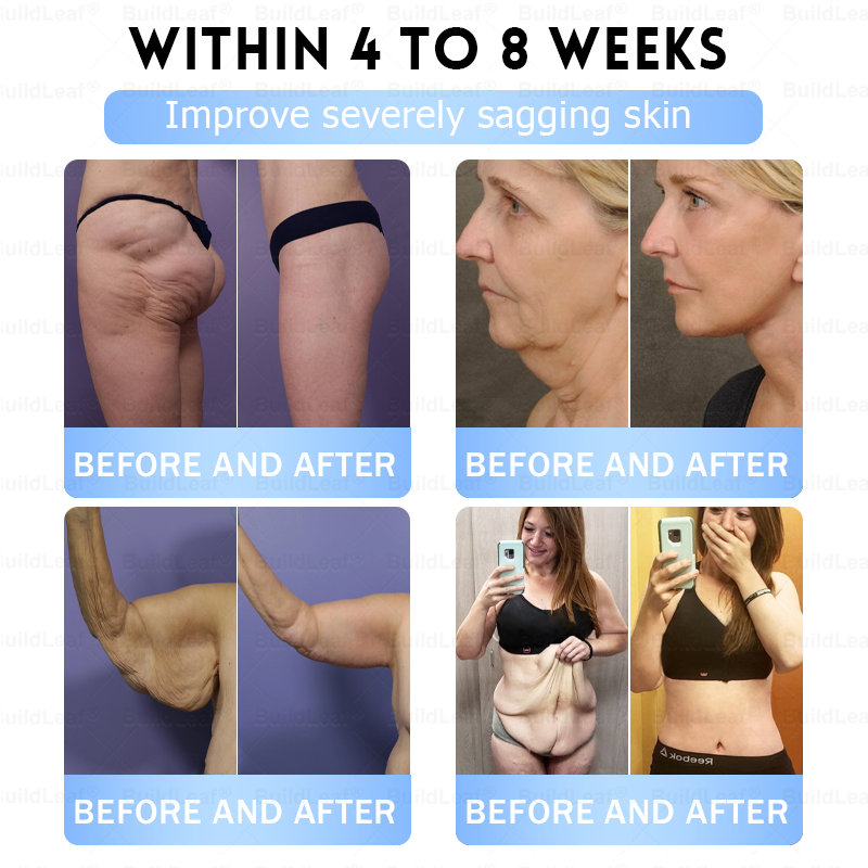 🇨🇦🇨🇦🇨🇦𝐇𝐞𝐚𝐥𝐭𝐡 𝐂𝐚𝐧𝐚𝐝𝐚 |𝐵uil𝗱𝐿ea𝐟® 𝑮𝐋𝑃-1 Slim & Firm 𝑁ano 𝑀icroneedle 𝑃atch with Collagen,Turmeric&Matrixyl 3000 丨Obesity,Cardiovascular Diseas, Diabetes, Sleep Apnea, Joint Problems and More